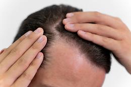 Perché proprio la Turchia per il trapianto di capelli? Il nuovo paradiso della calvizie