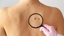 Tumori della pelle: oltre 17.000 casi di melanoma attesi nel 2025