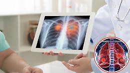 Tumore al polmone: 7 su 10 lo scoprono troppo tardi