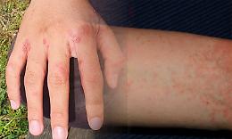 La scabbia torna a crescere in Italia: casi in aumento fino al 750%