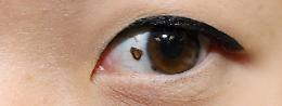 Melanoma oculare: riconoscerlo in tempo per proteggere la vista