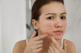 Arriva in Europa un trattamento innovativo per l'acne: cosa cambia per chi soffre di problemi di pelle