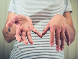 Morbillo, quasi 1 italiano su 10 è suscettibile al virus: i dati dello studio