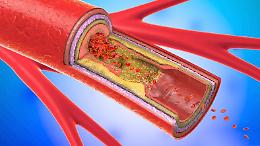 Evolocumab e stenosi carotidea: i risultati dello studio Caruso del Mauriziano di Torino