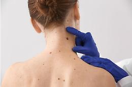 Melanoma, il 70% nasce da nei nuovi: lo studio che cambia la prevenzione