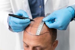Boom dei trapianti di capelli: così l’Europa è diventata la nuova capitale dell’estetica maschile