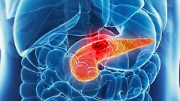 Tumore del pancreas, svolta dalla ricerca: un nuovo farmaco raddoppia la sopravvivenza 