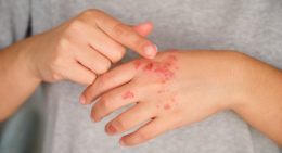 Psoriasi, oltre 1,5 milioni di italiani colpiti: impatto forte su vita sociale e lavoro
