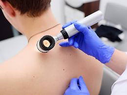 Melanoma in Piemonte, scatta l'allarme: casi in aumento e liste d'attesa bloccate