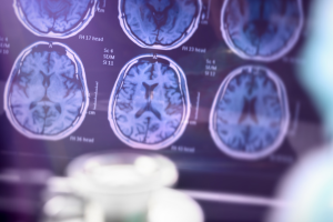 Alzheimer, la diagnosi fa un balzo nel futuro: primo test del sangue approvato, l’Italia protagonista