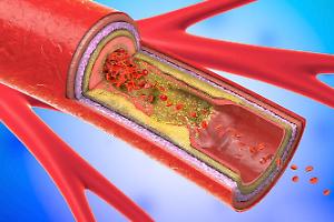Evolocumab e stenosi carotidea: i risultati dello studio Caruso del Mauriziano di Torino