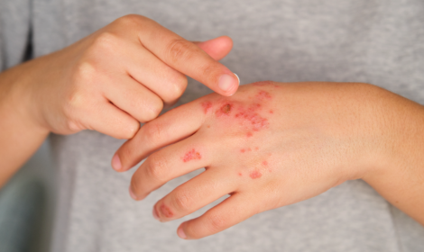 Psoriasi, oltre 1,5 milioni di italiani colpiti: impatto forte su vita sociale e lavoro